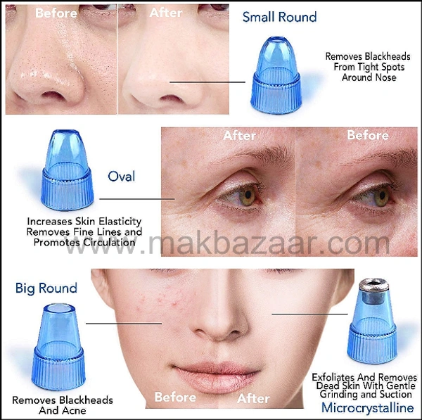 4 In 1 Blackhead Whitehead Extractor Remover Device, Acne, Pimple, Pore Cleaner, Vacuum Suction Tool With 4 Suction Head For Men And Women, Blackhead Remover Machine, Blackhead Remover ..